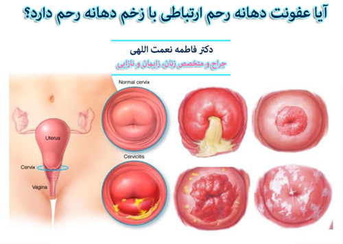 آیا عفونت دهانه رحم ارتباطی با زخم دهانه رحم دارد؟