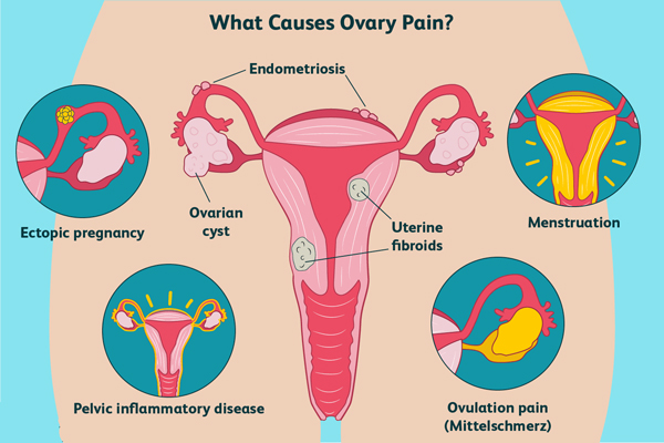 چه دلایلی باعث درد تخمدان می شود؟
