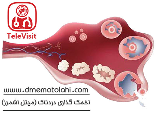 تخمک گذاری دردناک (میتل اشمرز)