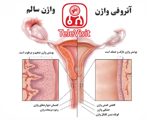 نازک شدن دهانه رحم یا آتروفی واژن