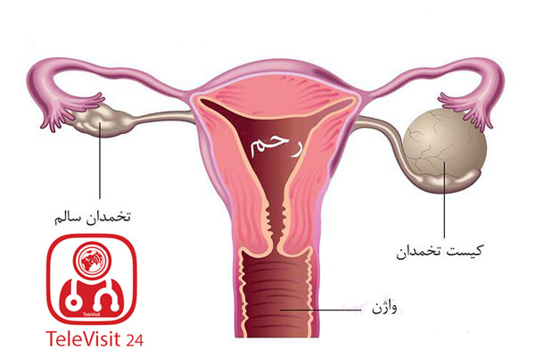 کیست تخمدان