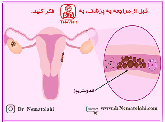دانستنیهایی در مورد اندومتریوز