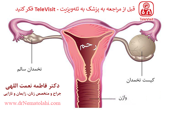 کیست تخمدان، درمان و تاثیرش در ناباروری