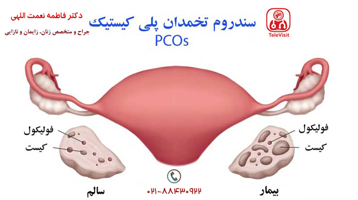 چگونه بفهمیم با PCOS به طور منظم تخمک گذاری می کنیم؟