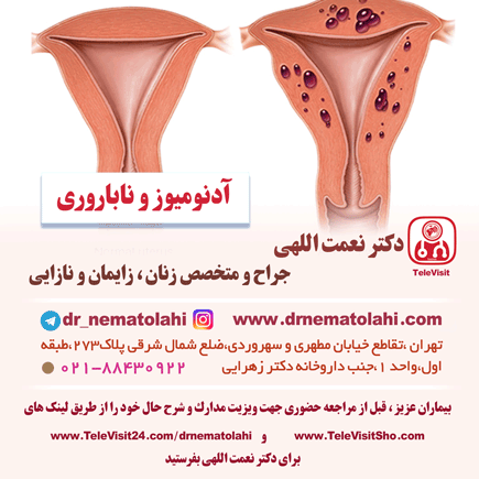 آدنومیوز و ناباروری