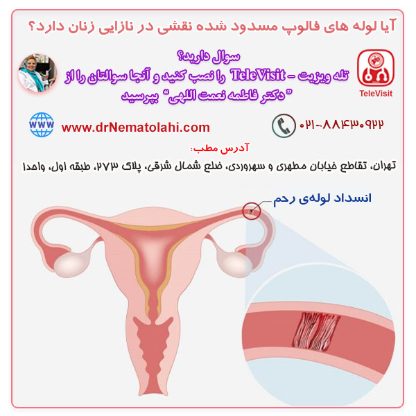 آیا لوله های فالوپ مسدود شده نقشی در نازایی زنان دارد؟