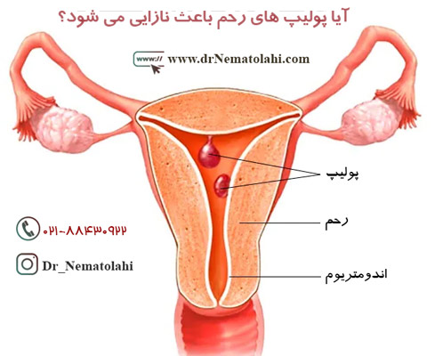 آیا پولیپ های رحم باعث نازایی می شود؟