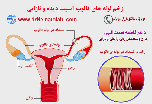 زخم لوله های فالوپ آسیب دیده و نازایی