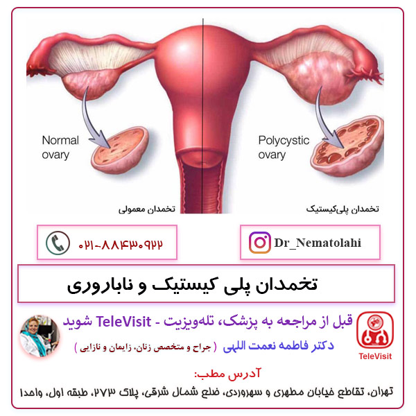 تخمدان پلی کیستیک و ناباروری