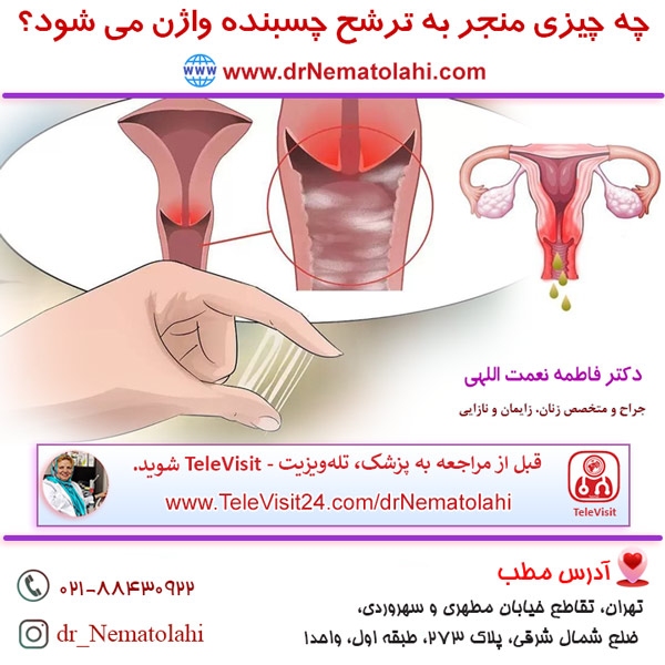 چه چیزی منجر به ترشح چسبنده واژن می شود؟