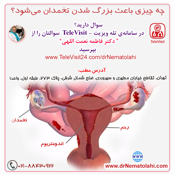 چه چیزی باعث بزرگ شدن تخمدان می‌شود؟