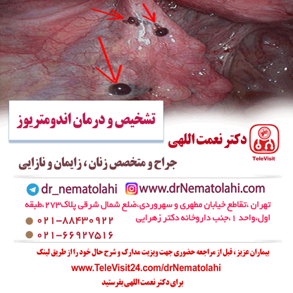 تشخیص و درمان اندومتریوز