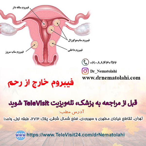 فیبروم خارج از رحم