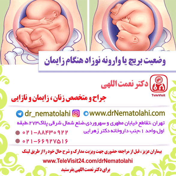 وضعیت بریچ نوزاد هنگام زایمان