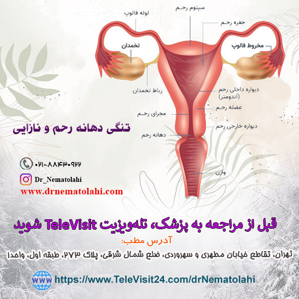 تنگی دهانه رحم و نازایی