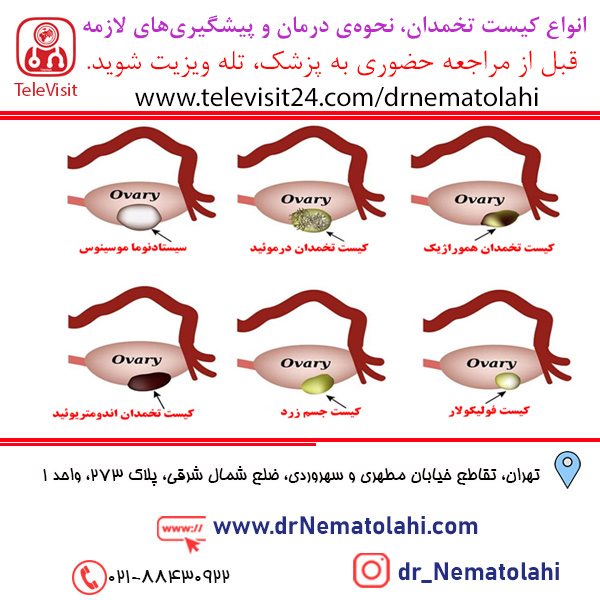 انواع کیست تخمدان، نحوه ی درمان و پیشگیری های لازمه