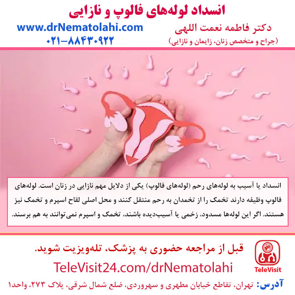انسداد لوله‌های فالوپ و نازایی