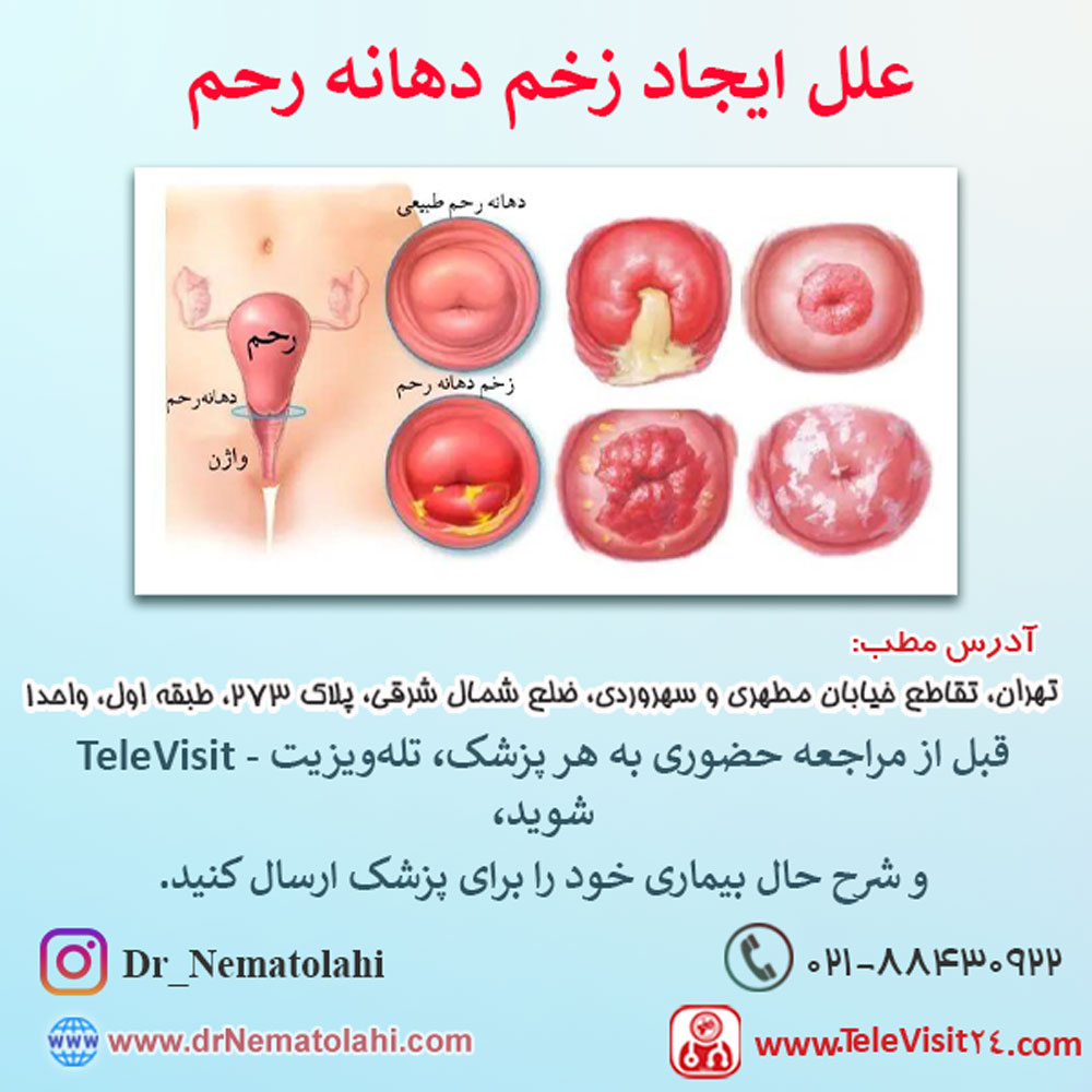 علل ایجاد زخم دهانه رحم