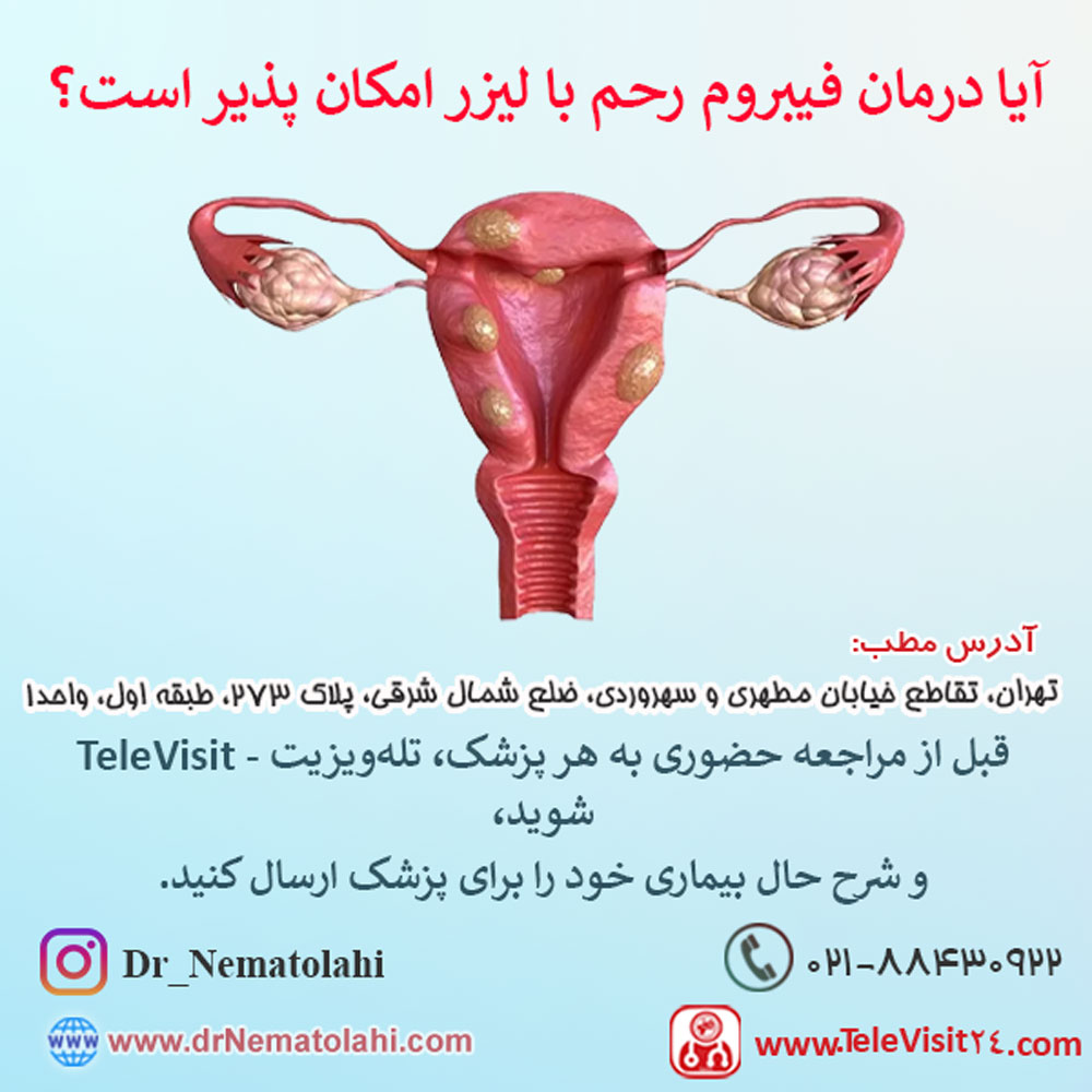 آیا درمان فیبروم رحم با لیزر امکان پذیر است؟
