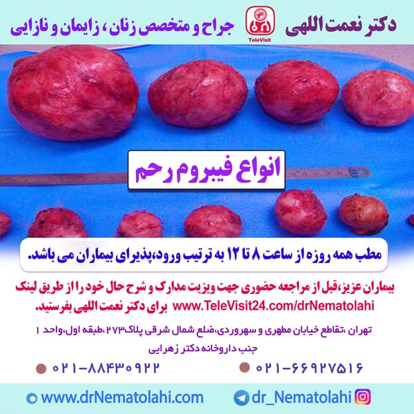 انواع فیبروم رحم
