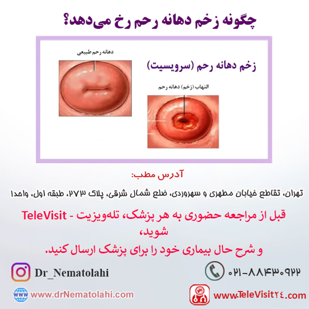 چگونه زخم دهانه رحم رخ می‌دهد؟