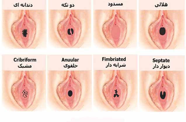 پرده بکارت و انواع پرده بکارت