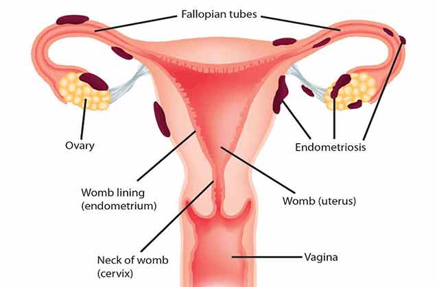 اندومتریوز چیست؟ 