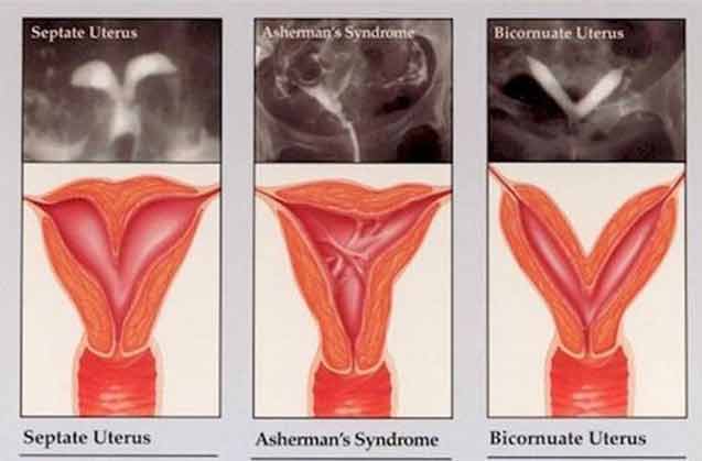 سندرم اشرمن Asherman Syndrome 