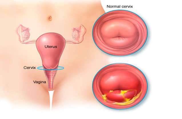 عفونت باکتریایی واژن (بهداشت جنسی زنان) 