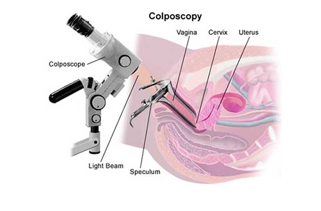 کولپوسکوپی چیست؟ 