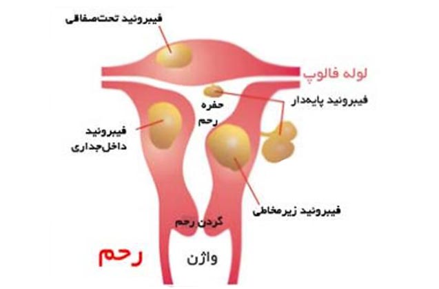 فیبروم رحمی