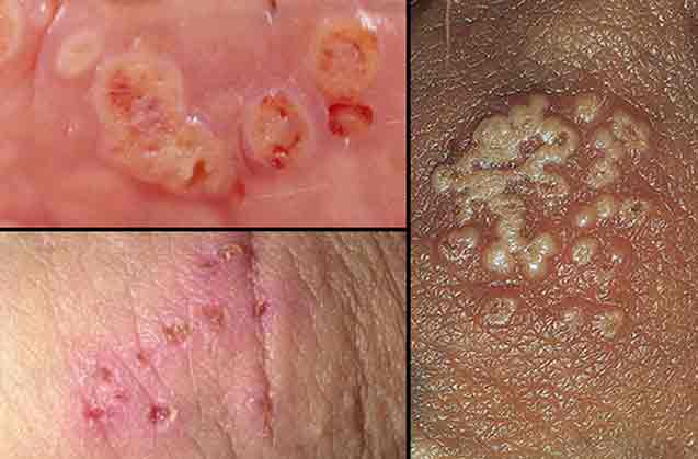 HPV های خطرناک 