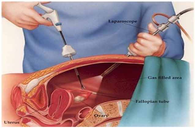 	لاپاراسکوپی چیست؟ 