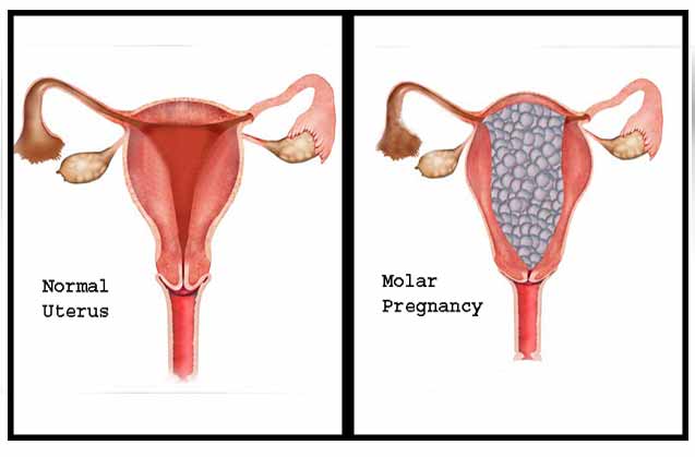 حاملگی مولار یا بچه خوره 