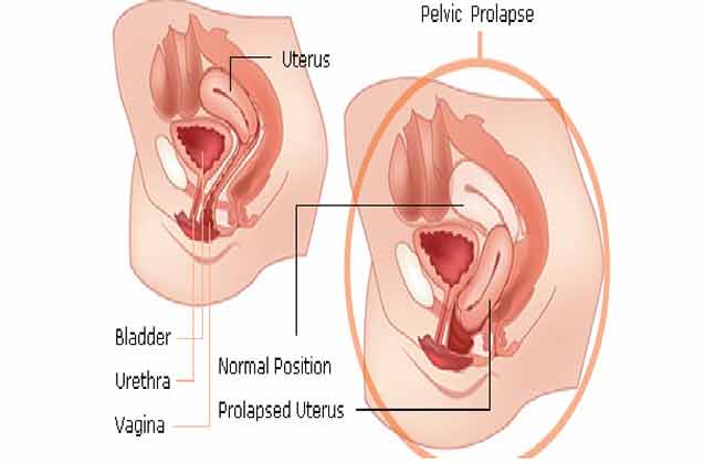 	افتادگی رحم و درمان آن 