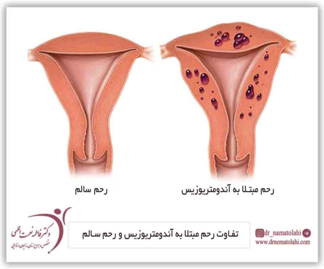 تفاوت رحم مبتلا به آندومتریوزیس و رحم سالم