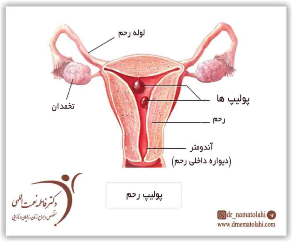 پولیپ رحم