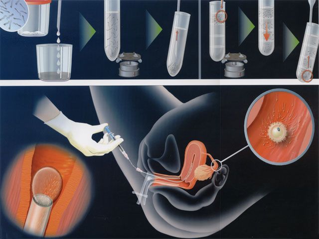 روش های نوین باروری:  تلقیح داخل رحمی اسپرم (IUI)