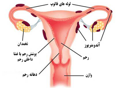 آندومتریوز