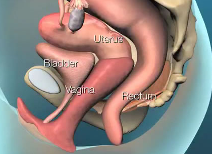 درمان افتادگی مثانه و رحم