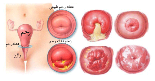 زخم دهانه رحم و نازایی