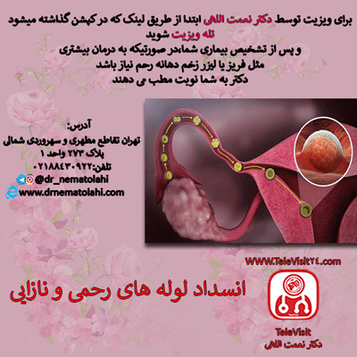 انسداد لوله های رحمی