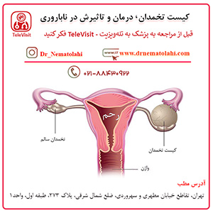 کیست تخمدان، درمان و تاثیرش در ناباروری